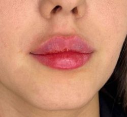 آموزش صفر تا صد تزریقات و زیبایی و مدرک معتبر