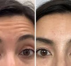 مدل برای تزریق فیلر و بوتاکس