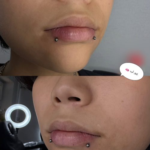 خدمات ژل لب فیلر بوتاکس مزو تراپی چالگونه پرسینگ