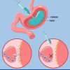 بوتاکس معده (فقط 10 میلیون تومان)