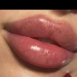 ژل و بوتاکس