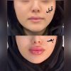 خدمات ژل لب فیلر بوتاکس مزو تراپی چالگونه پرسینگ