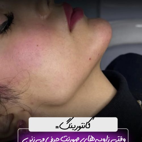 فیلر بوتاکس و مزوتراپی