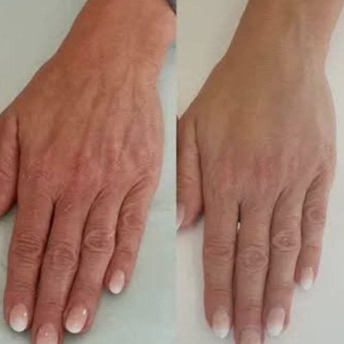 پرولیفت صورت و بدن