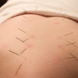 طب سوزنی و سوجوک تراپی توسط پزشک