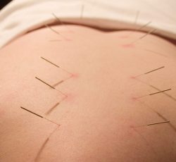 طب سوزنی و سوجوک تراپی توسط پزشک