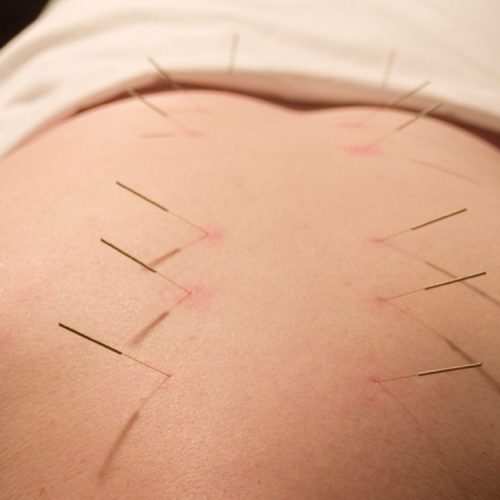 طب سوزنی و سوجوک تراپی توسط پزشک