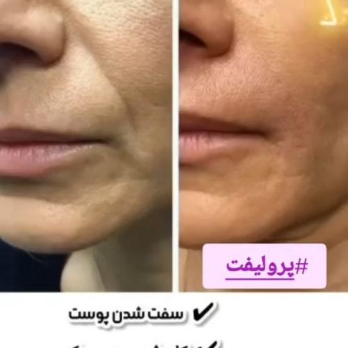 پرولیفت صورت و بدن