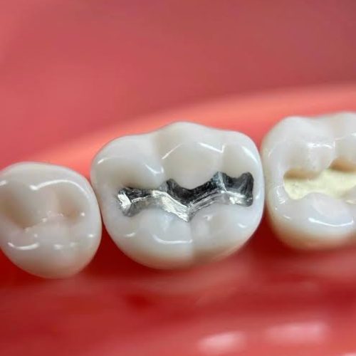 ترمیم دندان پوسیده در مرکز دندانپزشکی دولتی