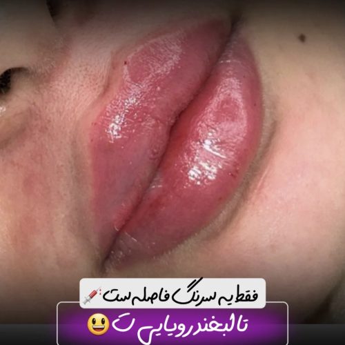 فیلر بوتاکس و مزوتراپی