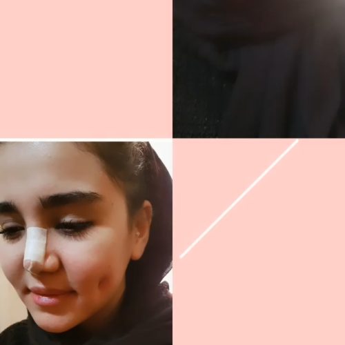 خدمات ژل لب فیلر بوتاکس مزو تراپی چالگونه پرسینگ