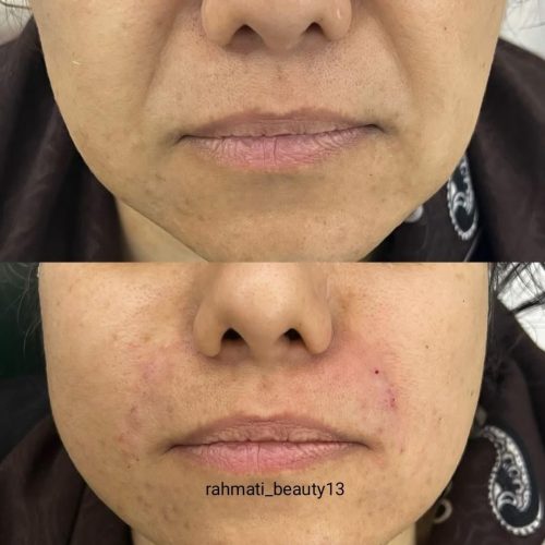 خدمات ژل لب فیلر بوتاکس مزو تراپی چالگونه پرسینگ