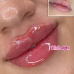 تزریق ژل و بوتاکس با قیمت های باور نکردنی