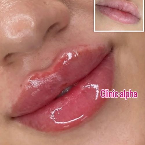 تزریق ژل و بوتاکس با قیمت های باور نکردنی
