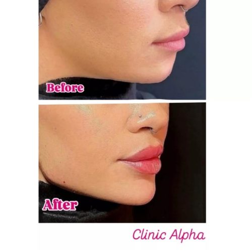 تزریق ژل و بوتاکس با قیمت های باور نکردنی