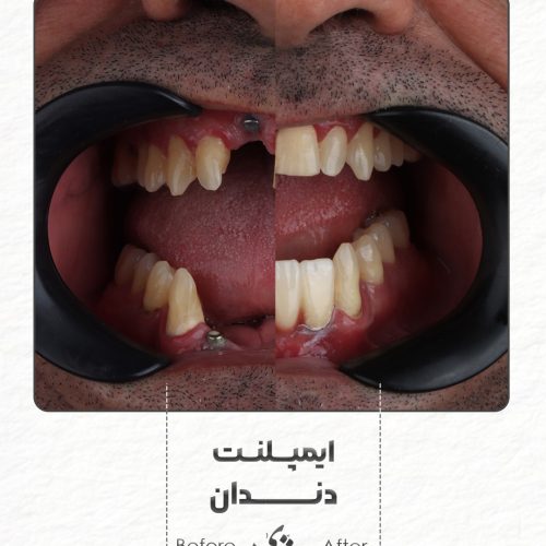 ایمپلنت بدون پیش پرداخت