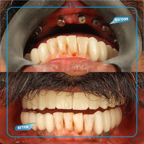 ایمپلنت بدون پیش پرداخت