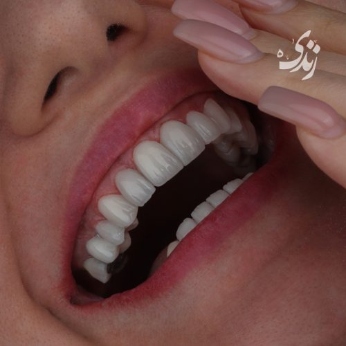 کامپوزیت بدون پیش پرداخت