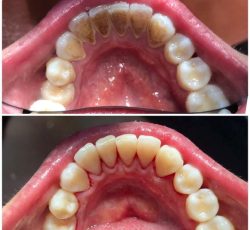 جرم گیری دندان با دستگاه