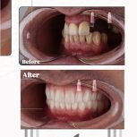 ایمپلنت بدون پیش پرداخت