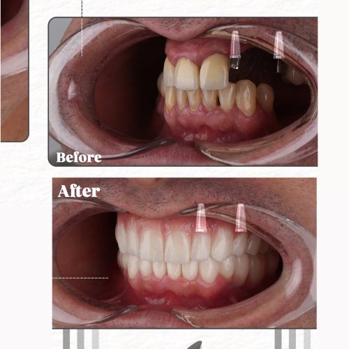 ایمپلنت بدون پیش پرداخت