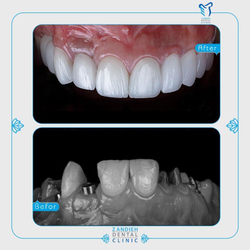 ایمپلنت بدون پیش پرداخت