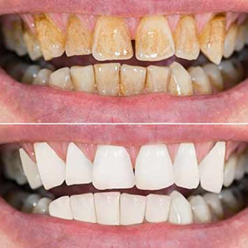 جرم گیری دندان با دستگاه