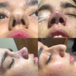 جراحی بینی با بهترین متد