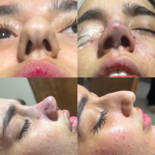 جراحی بینی با بهترین متد