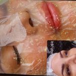 درمان تیرگی و از بین بردن ککو مک ودست و صورت