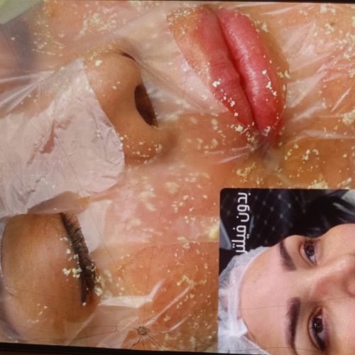 درمان تیرگی و از بین بردن ککو مک ودست و صورت