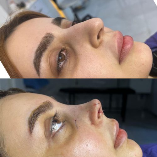 جراحی بینی با بهترین متد