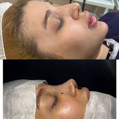 جراحی بینی با بهترین متد