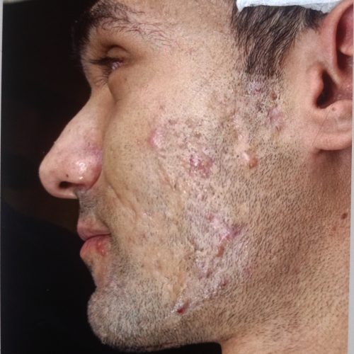 درمان تیرگی و از بین بردن ککو مک ودست و صورت