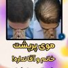 درمان قطعی ریزش مو