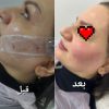 کلیه خدمات فیلر و بوتاکس