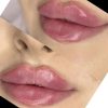 کلیه خدمات فیلر و بوتاکس