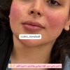 تزریق ژل و بوتاکس و جوانسازی صورت