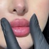 تزریق ژل بوتاکس