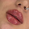 تزریق ژل بوتاکس