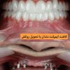 کاشت ایمپلنت تخصصی با اقساط ویژه و خدمات دندانپزشکی حرفه ای