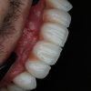 کاشت ایمپلنت تخصصی با اقساط ویژه و خدمات دندانپزشکی حرفه ای