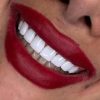 دندانپزشکی کامپوزیت روکش عصب کشی و ترمیم