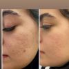 خدمات پی ار پی ،پی ار آف ،تزریق بوتاکس ،تزریق ویتامین C،مزو تراپی مو،مزو ژل