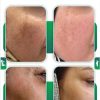 خدمات پی ار پی ،پی ار آف ،تزریق بوتاکس ،تزریق ویتامین C،مزو تراپی مو،مزو ژل