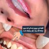 کامپوزیت دندان با برندهای اصل هر فک از ۲۰م